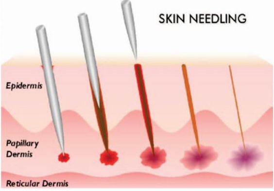 skin needling